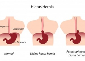 Hiatal-Hernia-in-Three-Parts-390x279