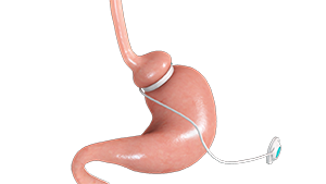 Benefits of Adjustable Gastric Band Surgery: Reversibility